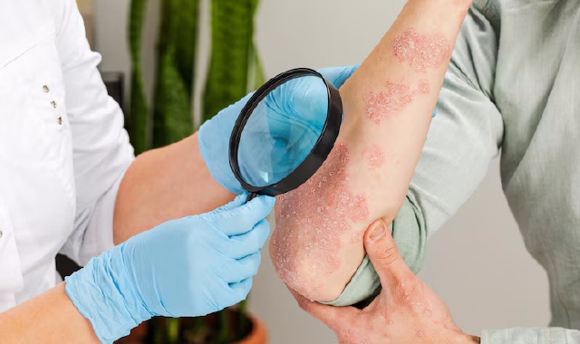 Nuovo farmaco biologico per la psoriasi più cattiva